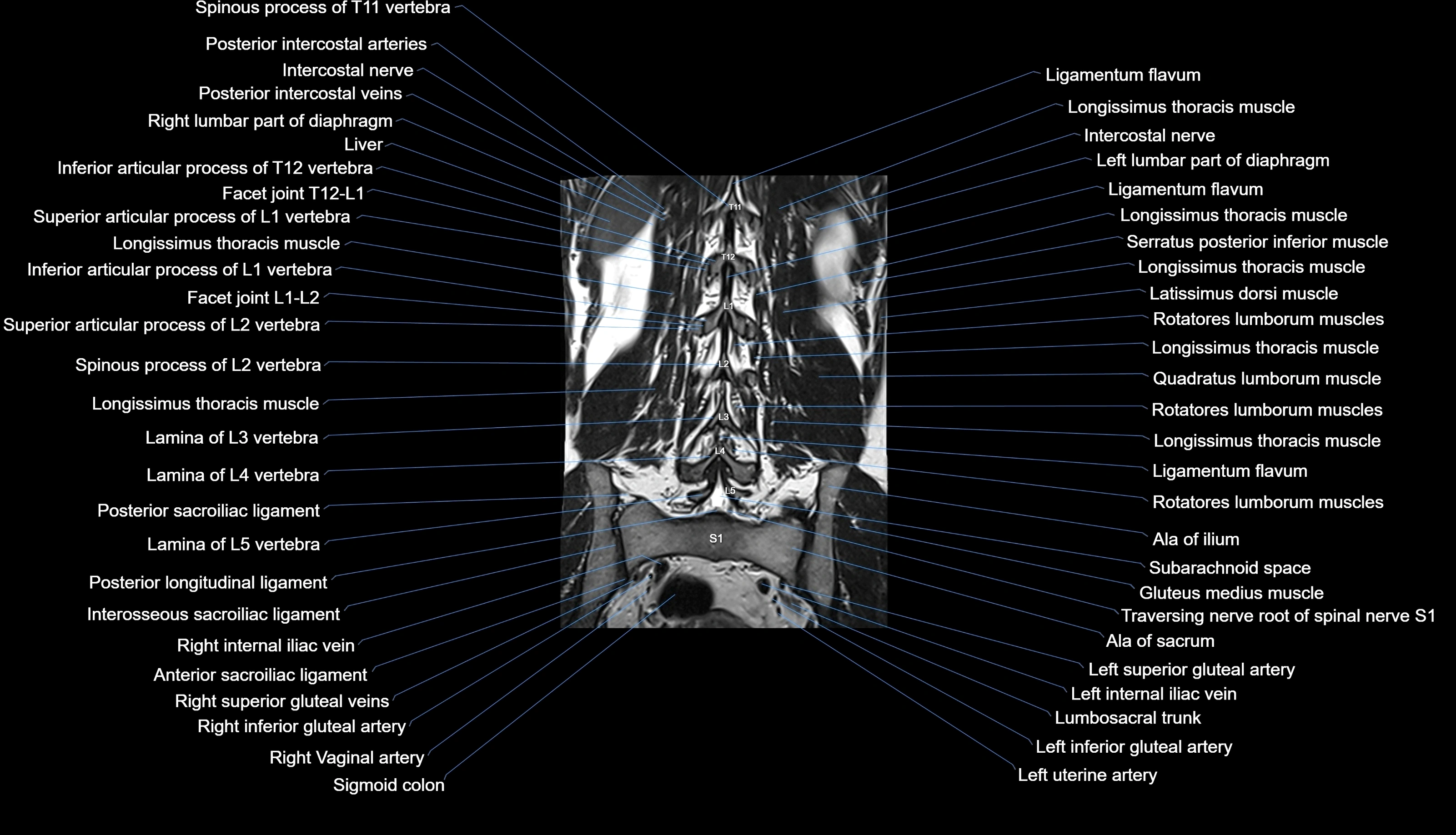 MRI lumbar spine labelled coronal cross sectional anatomy 3T radiology-img-00001-00024.webp